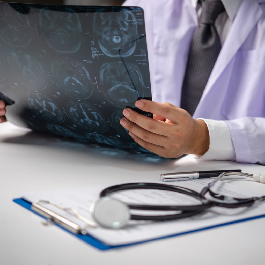 aneurisma cerebral en Perú – síntomas y prevención